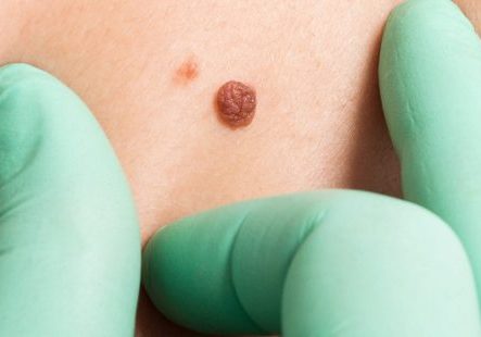 skin-lesion-p5lhmaxuyxhvonoywj8y8jvzipef2jzpmdfb9trxhc