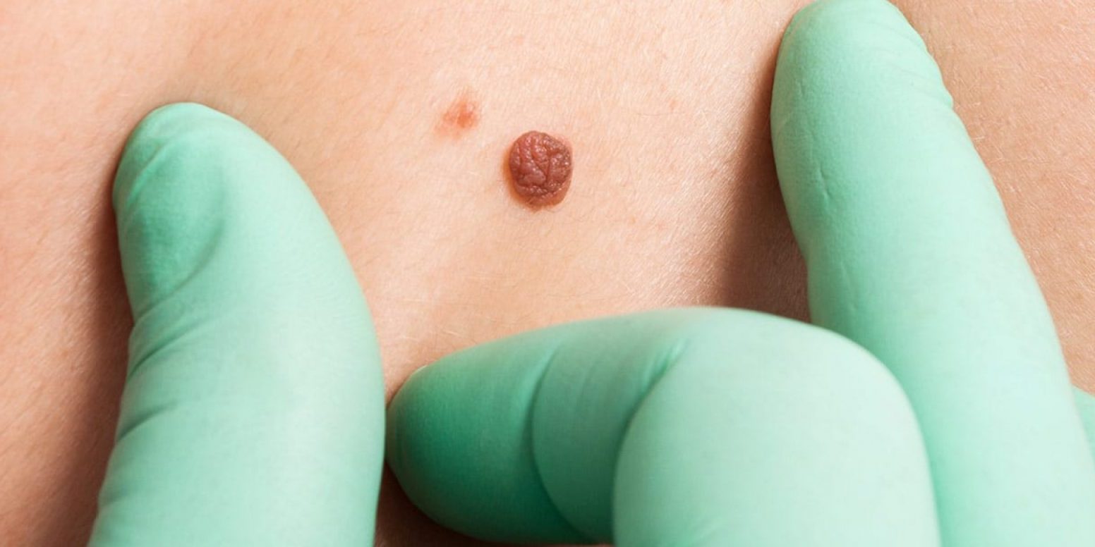 skin-lesion-p5lhmaxuyxhvonoywj8y8jvzipef2jzpmdfb9trxhc